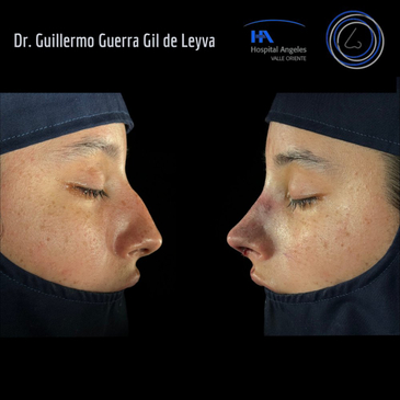 Slider image (10) Dr. Guillermo Guerra Gil de Leyva - Rhinoplasty Specialist